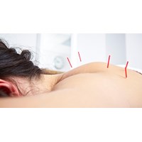 Châm cứu là gì? Có tốt không? Những ai không nên châm cứu?