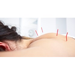 Châm cứu là gì? Có tốt không? Những ai không nên châm cứu?