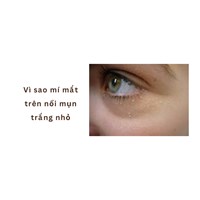 Vì sao mí mắt trên nổi mụn trắng nhỏ