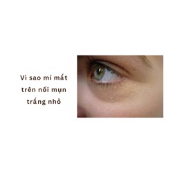 Vì sao mí mắt trên nổi mụn trắng nhỏ