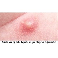 Cách xử lý  khi bị nổi mụn nhọt ở hậu môn