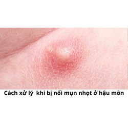 Cách xử lý  khi bị nổi mụn nhọt ở hậu môn