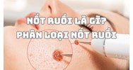 Nốt ruồi là gì? Phân loại nốt ruồi