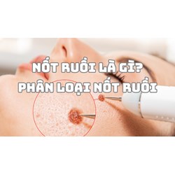 Nốt ruồi là gì? Phân loại nốt ruồi
