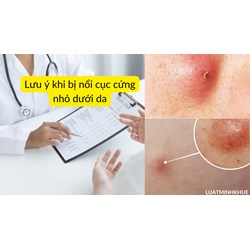 Lưu ý khi bị nổi cục cứng nhỏ dưới da
