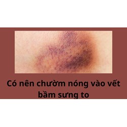 Có nên chườm nóng vào vết bầm sưng to không?