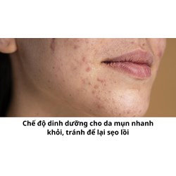 Chế độ dinh dưỡng cho da mụn nhanh khỏi, tránh để lại sẹo lồi