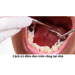 Cách trị đốm đen trên răng tại nhà
