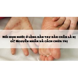 Nổi mụn nước ở lòng bàn tay bàn chân là bị gì? Nguyên nhân và cách chữa trị