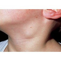 Nổi hạch sau tai có bị sao không?