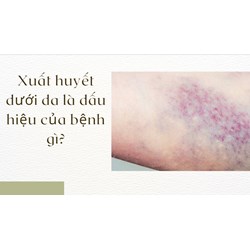 Xuất huyết dưới da là dấu hiệu của bệnh gì?