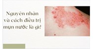 Nguyên nhân và cách điều trị mụn nước là gì?
