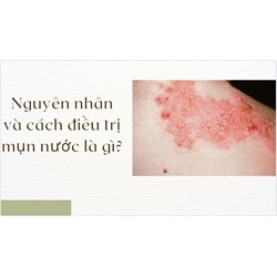 Nguyên nhân và cách điều trị mụn nước là gì?