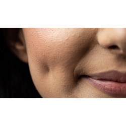Vì sao lại có má lúm đồng tiền?