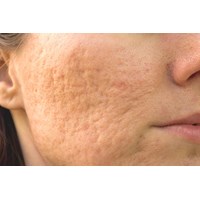 Ăn gì để nhanh liền sẹo?