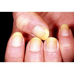 Móng tay có đốm trắng là dấu hiệu của bệnh gì?