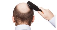 Nguyên nhân gây rụng tóc ở nam giới