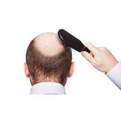 Nguyên nhân gây rụng tóc ở nam giới
