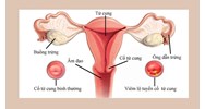 Phụ nữ nên ăn gì sau phẫu thuật cắt bỏ tử cung?