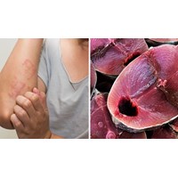 Hướng dẫn cách trị dị ứng cá biển