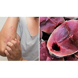 Hướng dẫn cách trị dị ứng cá biển