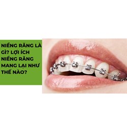 Niềng răng là gì? Lợi ích niềng răng mang lại như thế nào?
