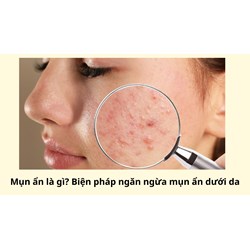 Mụn ẩn là gì? Biện pháp ngăn ngừa mụn ẩn dưới da