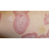 Bị hắc lào nặng chữa như thế nào?